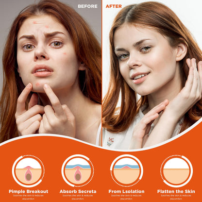 Advanced Hydrocolloid Acne Pimple Patches (60 Count) - Fast-Acting Spot Treatment for Blemishes and Breakouts | Vegan & Cruelty-Free Skin Care Solution